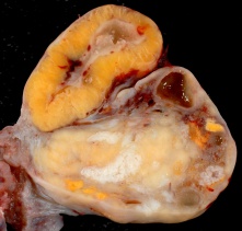 Human ovary - corpus luteum 01.jpg