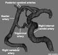 Trigeminal Artery