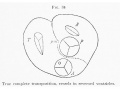 Fig 34 True complete transposition, vessels in reversed ventricles.