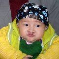 Image shows Bilateral Cleft Lip