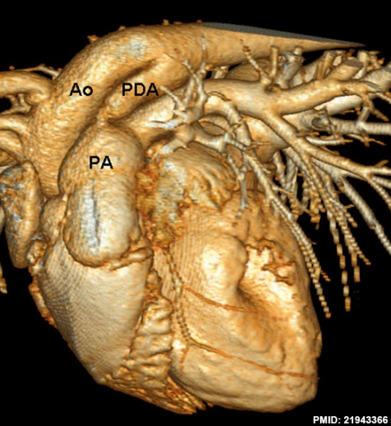 File:Dog patent ductus arteriosus computed tomography.jpg
