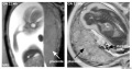Placenta MRI 22 and 32 week