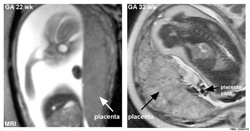 File:Placenta MRI 02.jpg