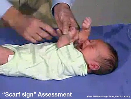 Neural Exam - Newborn tone - scarf sign - Embryology