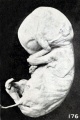 Fig. 176. Fetus showing gluing of hand to face. No. 316.