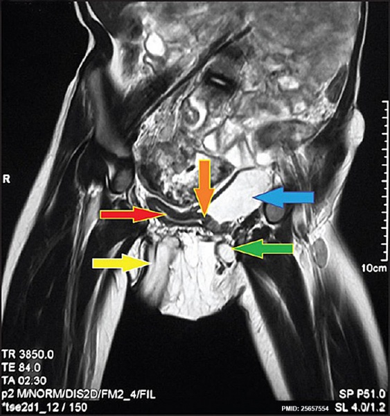 File:Neonatal duplicated bladder MRI 01.jpg