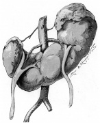 Renal System - Abnormalities - Embryology