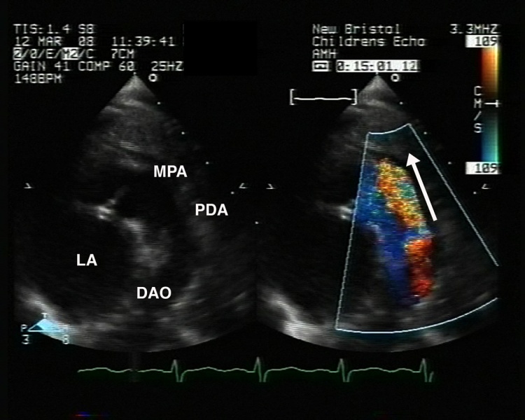File:Patent ductus arteriosus echocardiogram.jpg