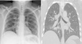 Chest CT lungs of a 36-year old woman CPAM