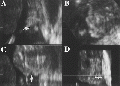Figure 2.A, Coronal, B, sagittal, C, transverse, and D, 3D rendered US images of a cleft lip (arrows) and palate in a fetus at 21 weeks gestational age. Image in D is viewed frontally. White line indicates plane depicted in C.