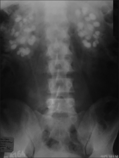 File:X-ray Abdomen bilateral nephrocalcinosis.jpg