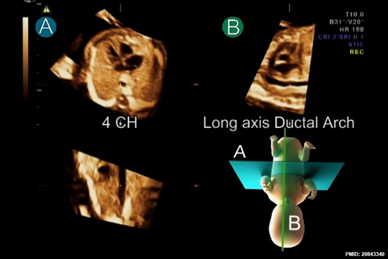 File:Fetal cardiac ultrasound 01.jpg