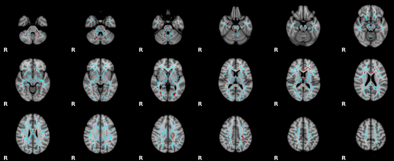 File:Human brain white matter tracts.png