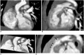 Scans of Supravalvular Aortic Stenosis and Pulmonary Stenosis.jpg
