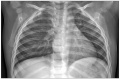 A preoperative chest PA showing a narrowed superior mediastinum suggesting thymic agenesis, apical herniation of the right lung and a resultant left sided buckling of the adjacent trachea air column