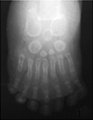 Left foot polydactyly x-ray