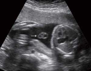 Placental cord ultrasound 04.jpg