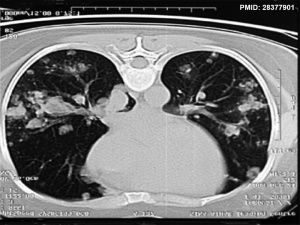 Hydatidiform mole pulmonary metastasis