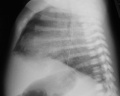chest radiography infant with MAS Z5178462 Description, reference, copyright and student template OK, relevant to project.