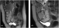 MRI Placenta accreta dark intraplacental bands