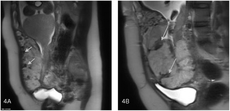 File:Placenta accreta MRI dark intraplacental bands.jpg