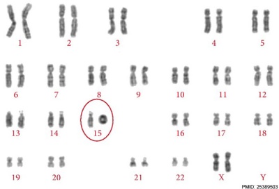 Ring chromosomal 15.jpg