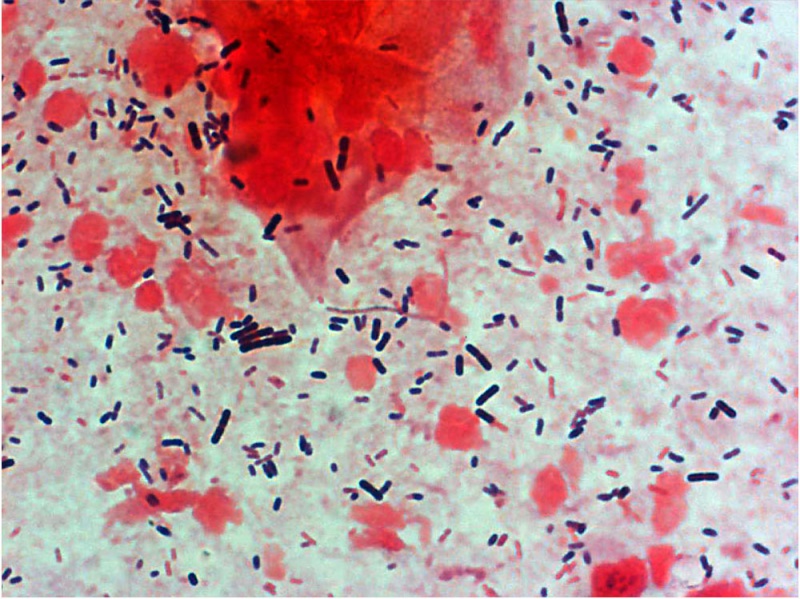 File:Bacteria - gram-stained vaginal smear 05.jpg