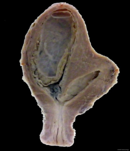 File:Bicornuate uterus01.jpg
