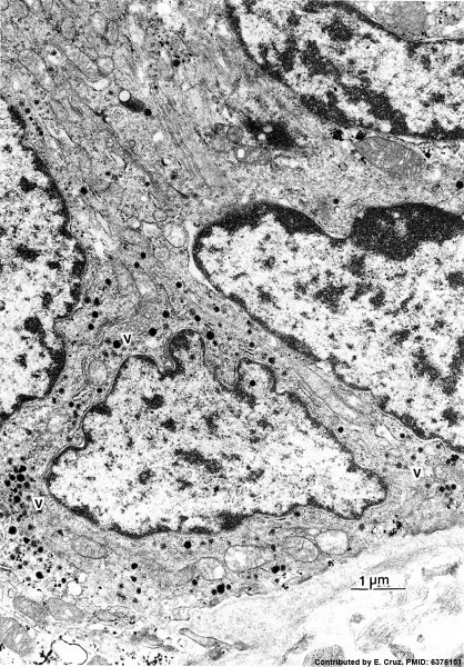 File:Neonatal human pulmonary neuroendocrine cell EM01.jpg