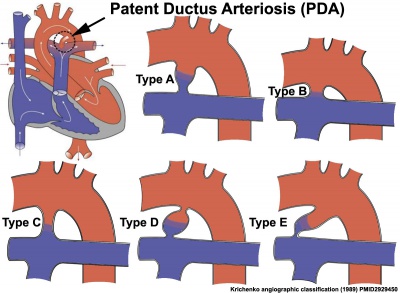 Patent ductus arteriosus classification cartoon