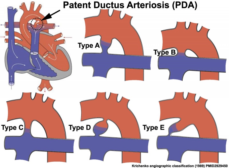 File:Patent ductus arteriosus classification.jpg
