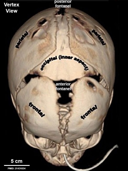 File:Skull CT normal sutures 03.jpg