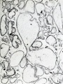 Fig. 12. Villi showing hydatiform degeneration. Same specimen as fig. 10.