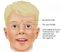 Fig 19. Facial features appearance in Fetal Alcohol Spetrum Disorder