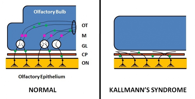 File:Normal Neuronal Migration into the Olfactory Bulb Compared to Kallmann's Syndrome.jpg