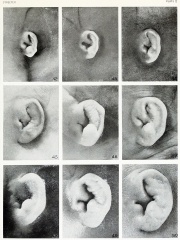 Hearing - Outer Ear Development - Embryology