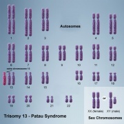 Trisomy 13