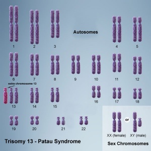 Chromosome- trisomy 13.jpg
