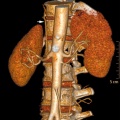 Accessory renal artery