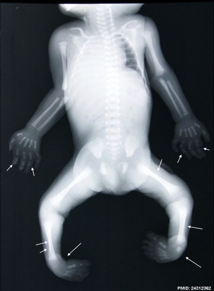 File:Fetal limb abnormalities X-ray-02.jpg