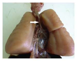 Postmortem revealing congenital laryngeal atresia