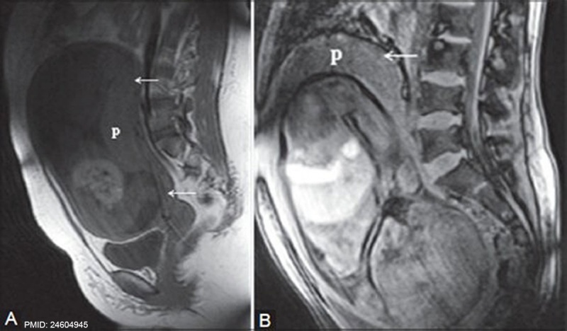 File:MRI placenta uterus posterior upper segment.jpg