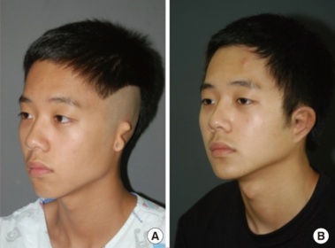 Microtia boy surgery.jpg
