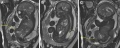 MRI of Cloacal extrophy