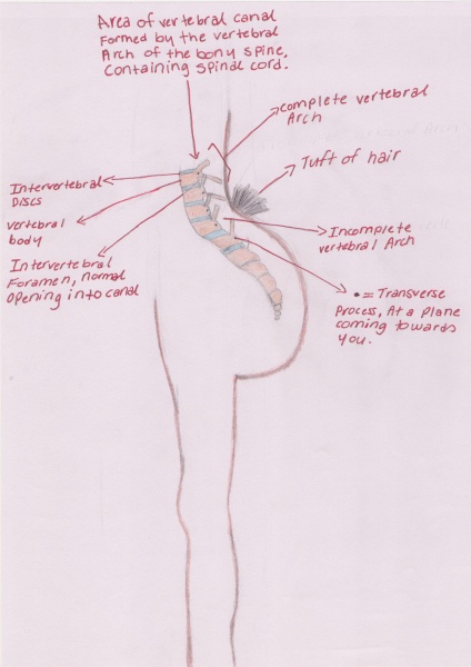 File:Spina bifida occulta 01.jpg