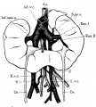 Fig. 2 Horseshoe kidney
