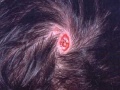Aplasia cutis congenita at the scalp. Existing Website image.