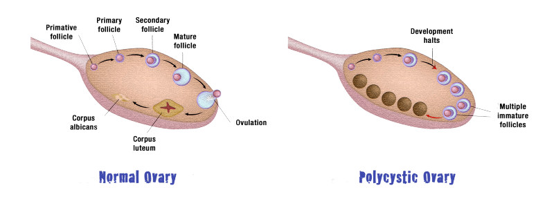 File:Normal ovary compared to polycystic ovary.png