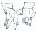 Partial Contracture of Hands, typical manifestation of Amyoplasia