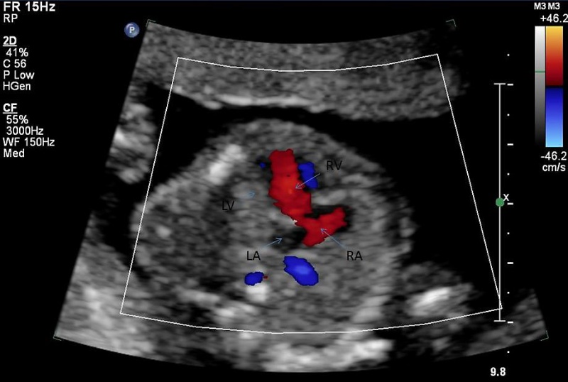 File:Ultrasound - Hypoplastic left heart syndrome 04.jpg